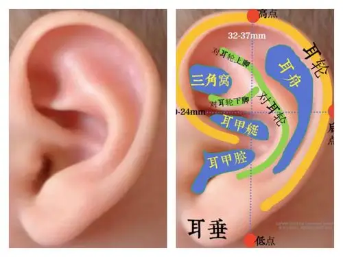 新生儿耳廓畸形无创矫正