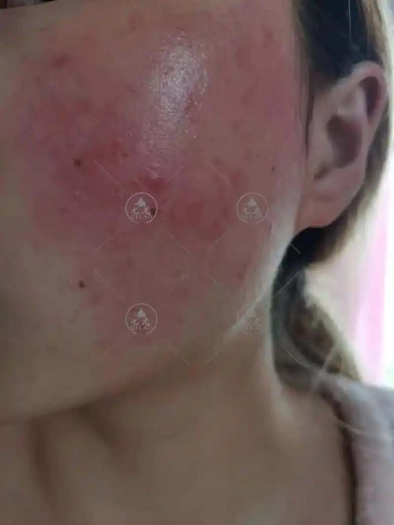 皮肤反复红烫,角质层薄,有红雪丝终于好了.#屏障受损 #红血 - 抖音