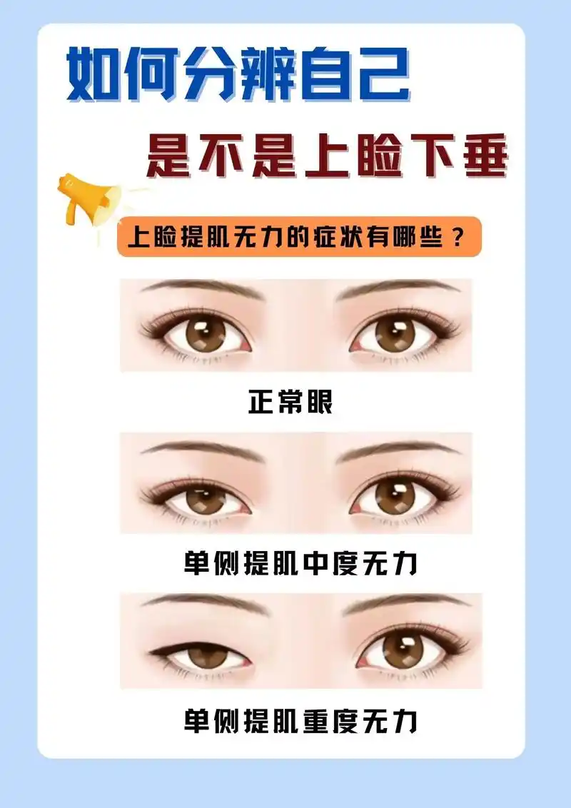 上睑下垂 #让我们一起变美  - 抖音