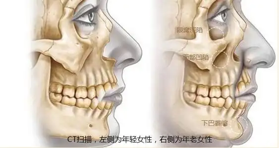 年轻只是对皱纹的修修补补,殊不知面部脂肪减少和骨骼变化也对衰老起
