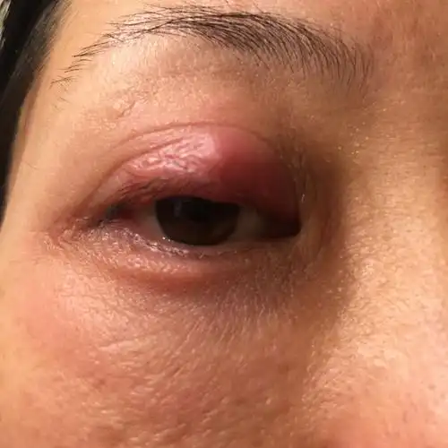 晚上哭了之后右眼睛就像这样肿了,已经肿两天了不见好也不敢抹药.