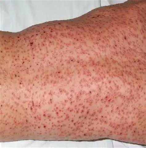 假性尖锐疣与真的照片