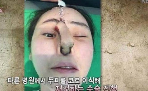 惊呆:女生整容垫鼻手术意外失败,惨变"猪鼻子"