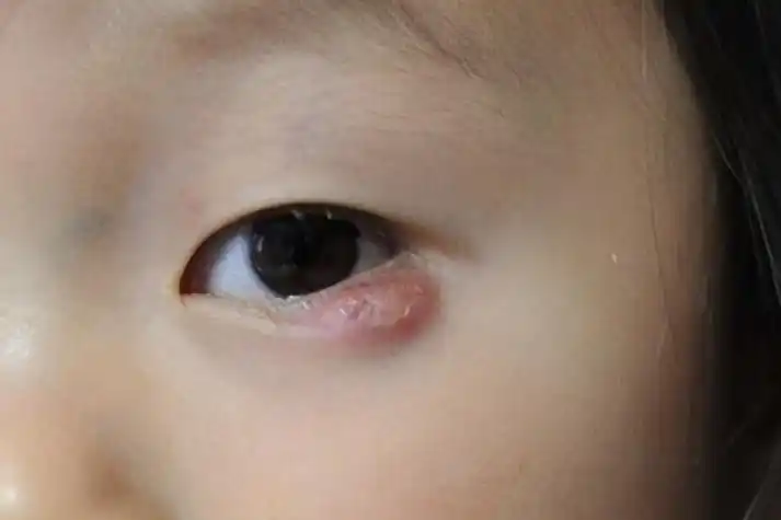 睑板腺囊肿表现为下眼睑皮下圆形肿块,一般无疼痛.