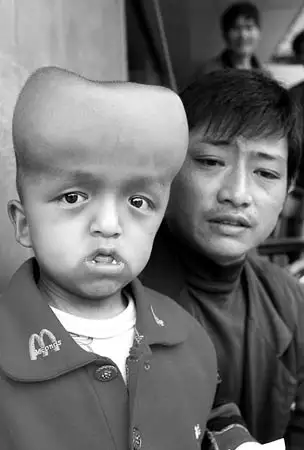 通讯员 高树灼) 9岁男孩刘京体重只有15公斤,脑袋却是常人的两个大,头