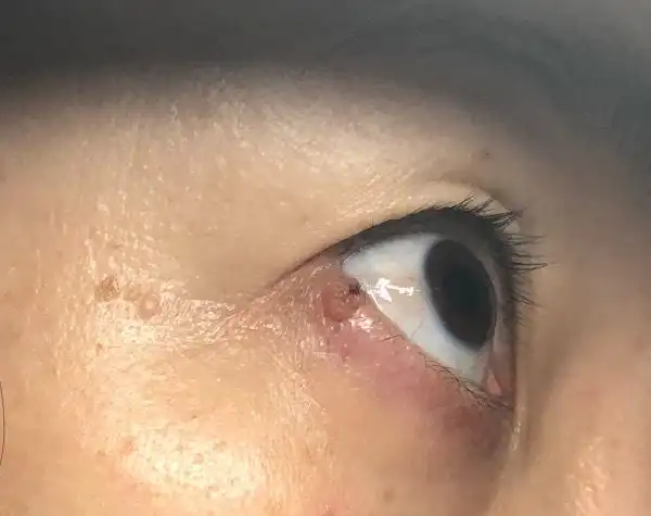 下眼睑外侧长了一堆小凸起,不痛不痒,挤压会出血,请问这是什么?