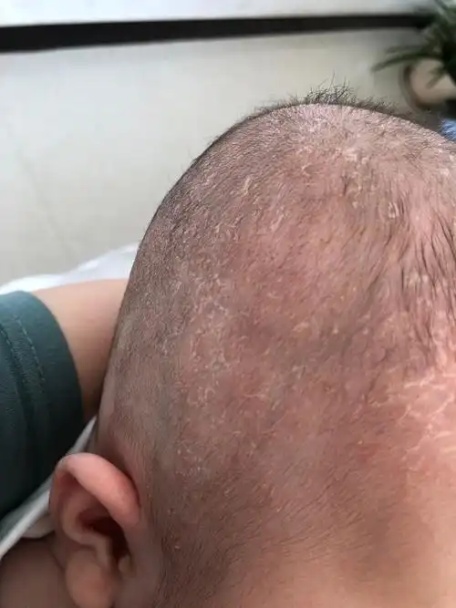 婴儿头皮起皮