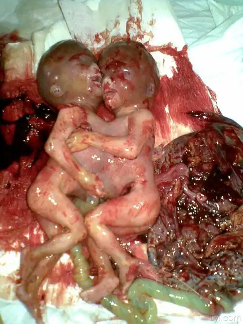 hate25292010-11-30 20:51:11最近一位b超发现连体婴儿的孕妇来引产