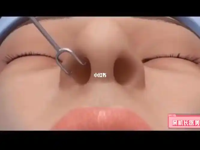 原来垫高鼻子是这样操作的