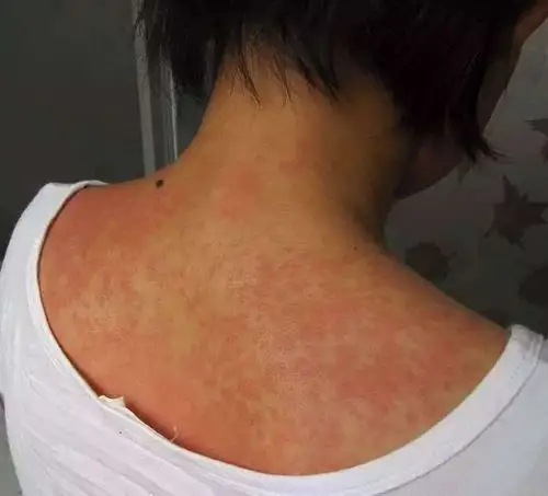 [美肤堂]春夏季节最易发5种皮肤病,不看不知道!