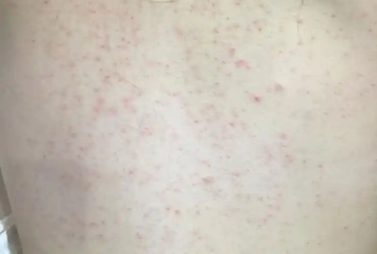 全身突然起了很多小红点 全身都有 脸上也是 现在有点发烧
