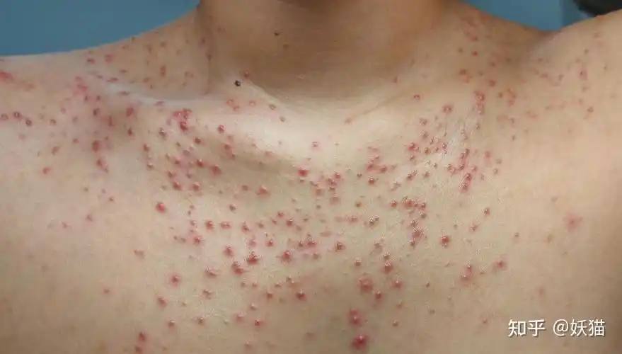 马拉色菌毛囊炎的治愈全过程(亲身经历)图片可能引起不适请谨慎观看