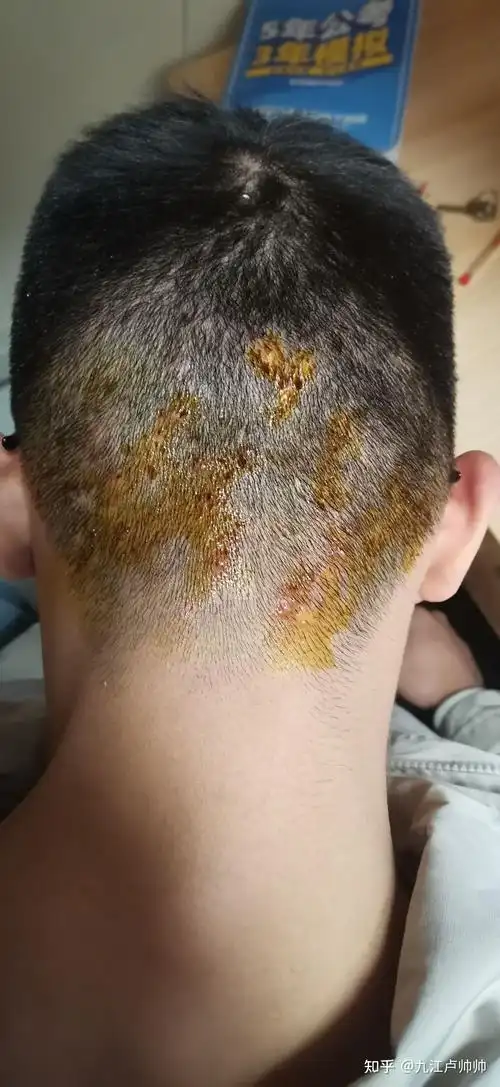 头皮毛囊炎的治疗之路! - 知乎