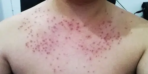 胸前有红点刚开始也就56个红点可能抹了黄皮肤牙膏等几
