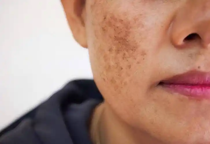 为何有的人满脸"黄褐斑",有的却很干净?说明什么?
