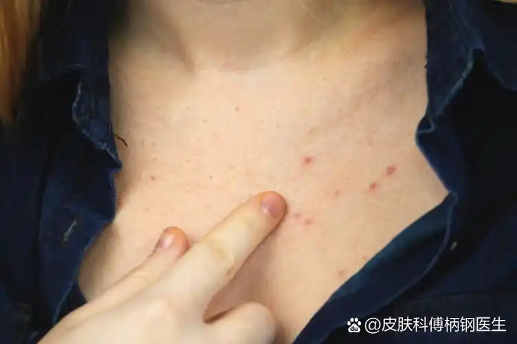 你问我答:胸口长了几个小红疙瘩,半年了一直不消,不痛不痒,请问是什么