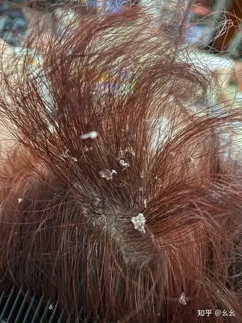 见过的最大头皮屑多大