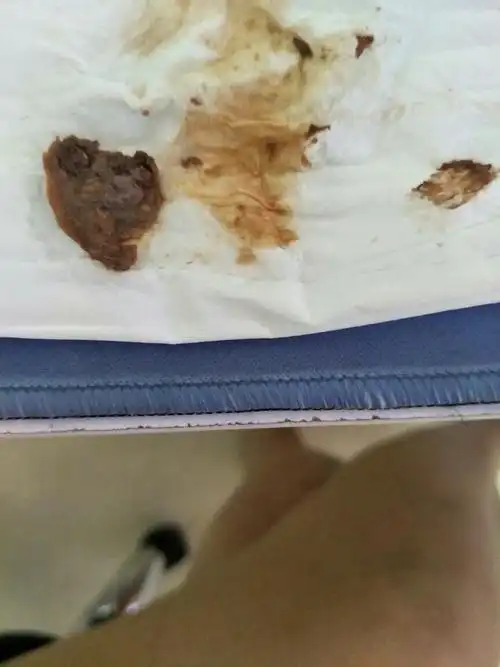 用了爱杰特银离子妇用抗菌胶凝第五天排出物