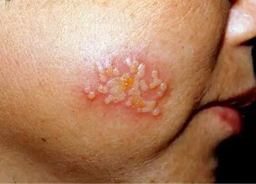 女性艾滋病感染者皮肤