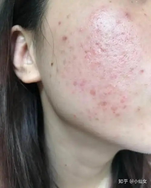 油性或混合偏油性的敏感皮肤该怎么护肤? - 知乎