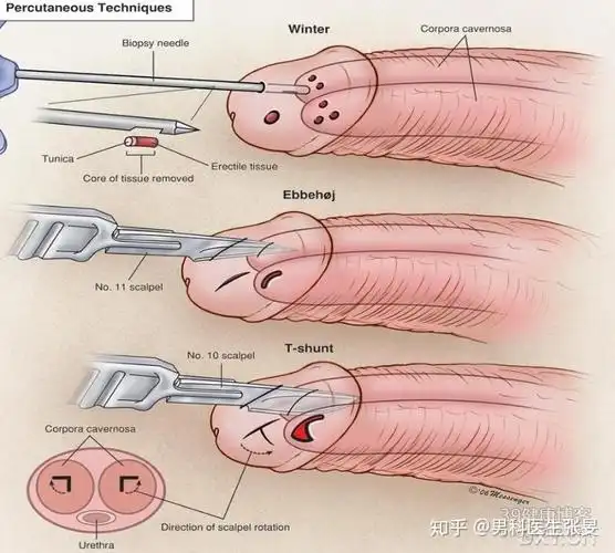 阴茎海绵体分流术高流量性阴茎异常勃起的治疗1,保守治疗:冰袋压迫