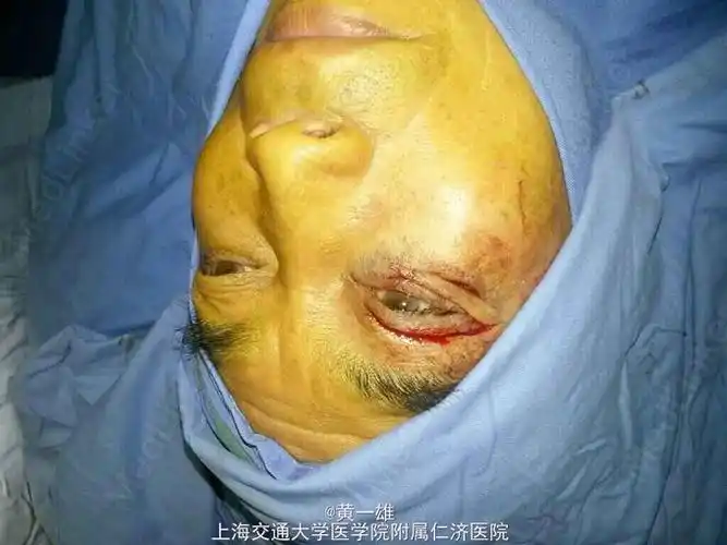 下眼睑部分外翻的手术