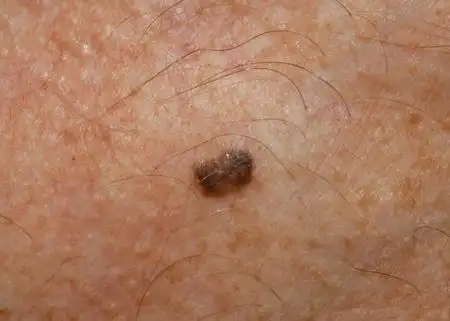 和肝癌相关的皮肤表现你知道吗这五种皮肤问题要引起注意