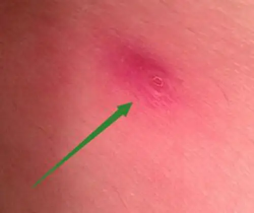 软下疳和硬下疳区别