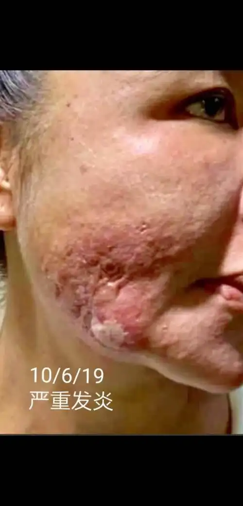 音视频moon老师分享微整形失败脸部皮肤三年溃烂用美极客产品恢复正常