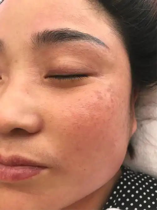 冉玲玲 皮肤暗黄 色斑