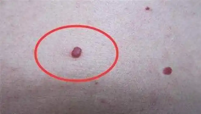肝癌不痛不痒一旦身上长这种小红点可能癌症离你更近一步