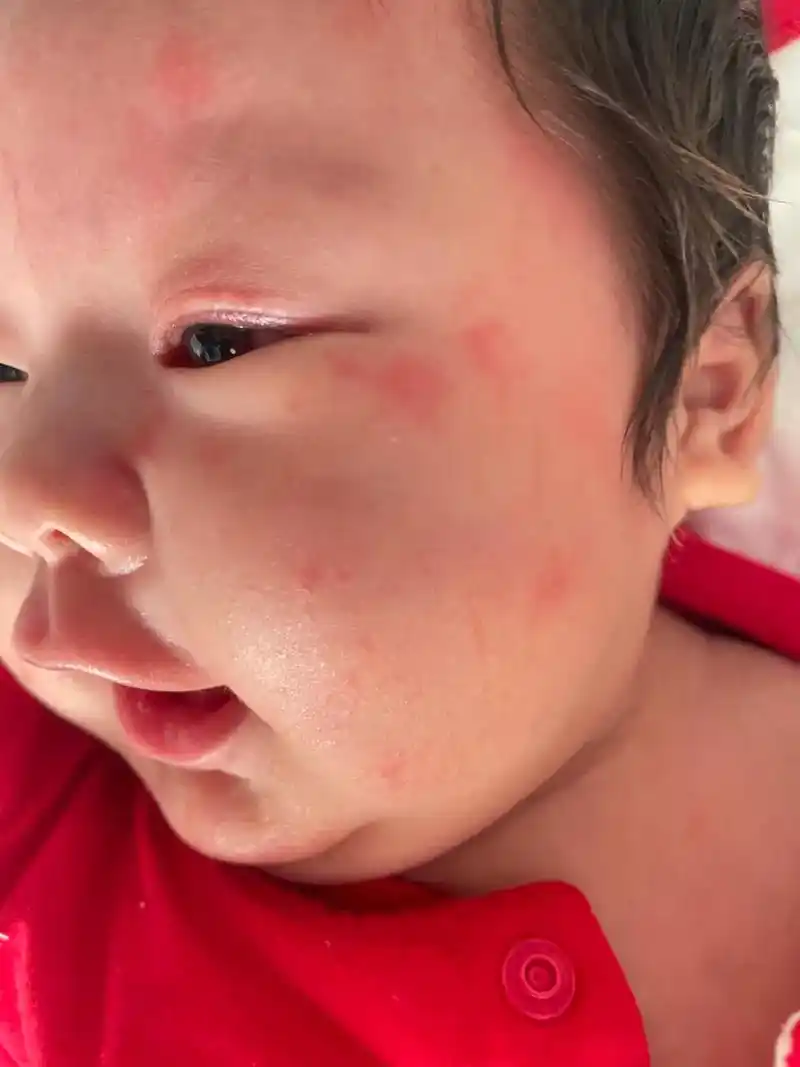 婴儿湿疹.宝宝两个月了,从出生到现在热疹一直很困扰,热一点脸 - 抖音