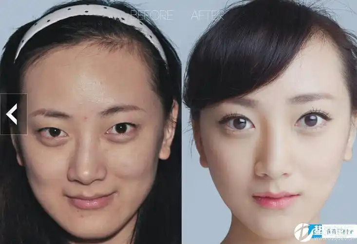 整容前后