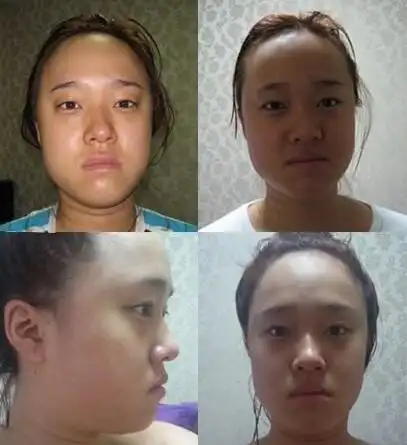 面部吸脂整形手术真实案例全新版前后对比照