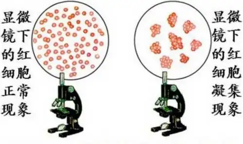 红细胞凝集(图片来源于网络)