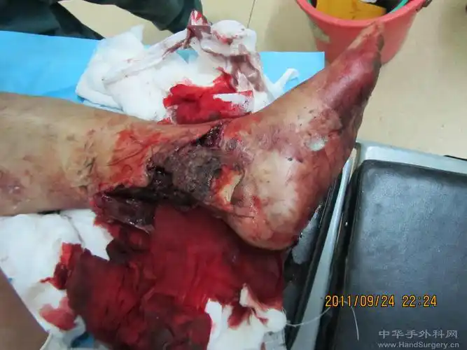 小腿下段严重碾压伤