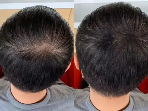 这个"生发"小技巧,能让秃了的人快乐无边!丨好物推荐_头皮