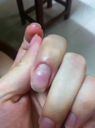 我的手指根部和指甲脱离 小太阳处已经裸露.请问这是什么病.