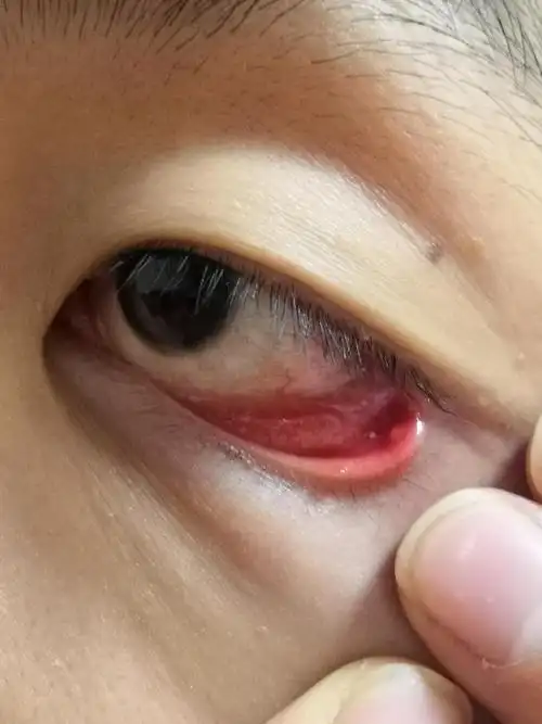 眼睑内下侧起了几个泡,是啥病?