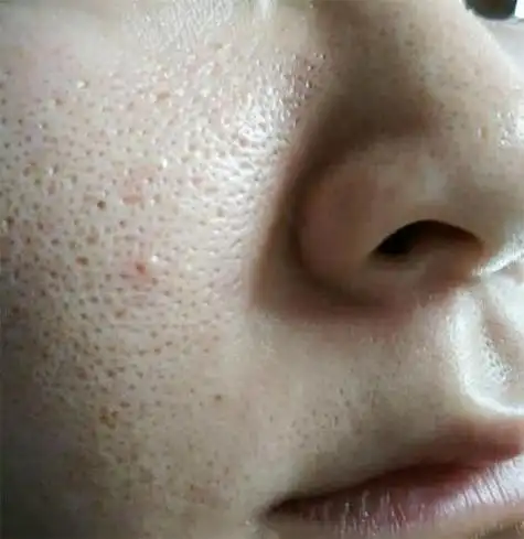 脸粗糙毛孔粗大怎么办 鼻子两侧毛孔粗大皮肤粗糙怎么办?