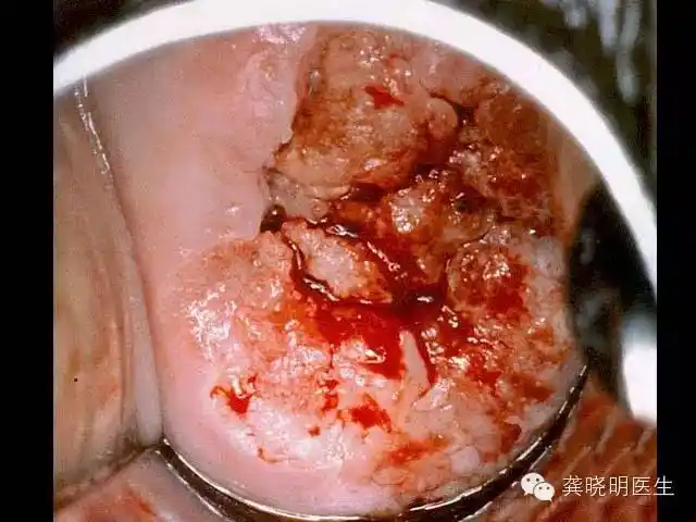 性交出血有哪些病因