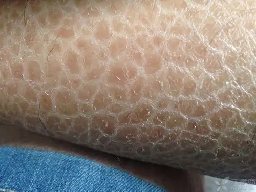 腿上鱼鳞状花瓣