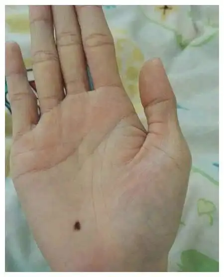 手上有一物不是贵就是富手掌有痣解读运势你有这颗痣吗