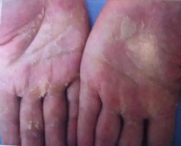 本病是一种掌跖部角质层浅表性剥脱性皮肤病,病因是由于皮内湿毒郁结