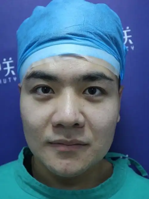 【鼻头鼻翼肥大】大鼻子男生的悄悄改变