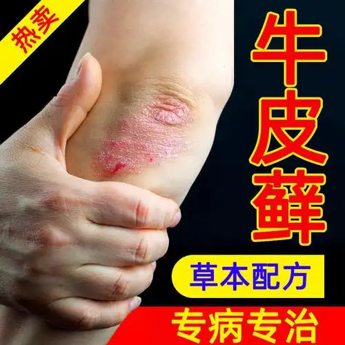 牛皮癣银屑病藓股湿疹止痒药膏皮肤瘙痒去根治疗牛皮癣专用的药