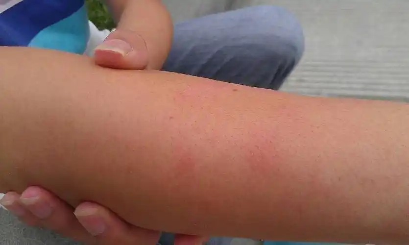 手臂上有皮肤病