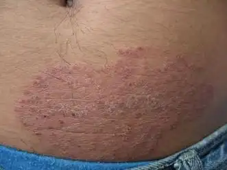 体癣是一种常见的具有传染性的真菌感染皮肤疾病,久治难愈,反复发作