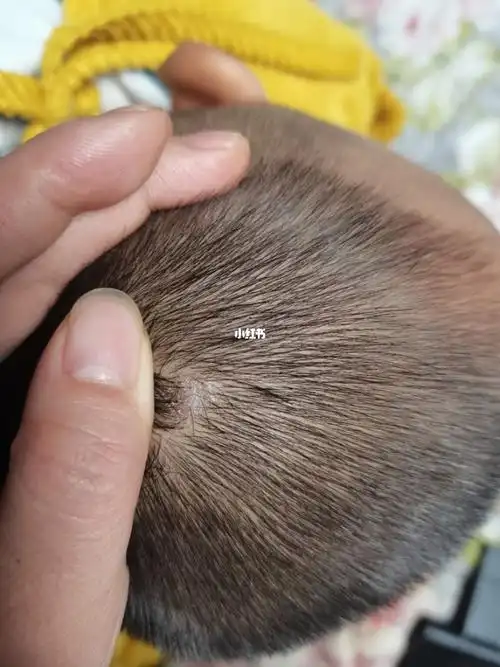 会是头皮癣吗?才一岁两个月