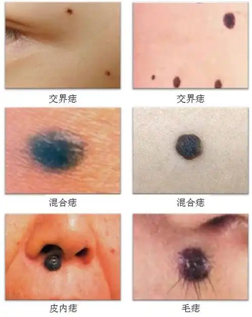 容易癌变的痣边缘参差不齐,呈锯齿样改变,与周围正常组织分界不清.
